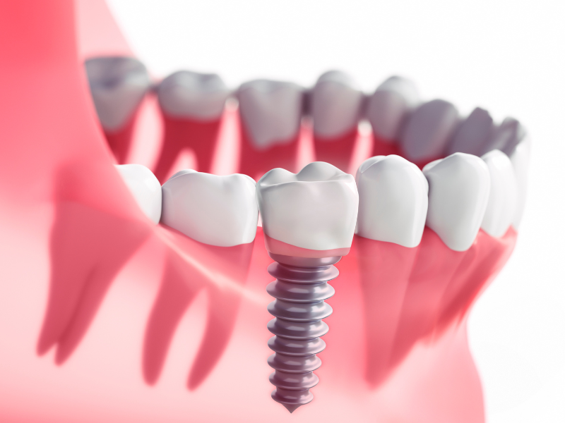 Dental Implants